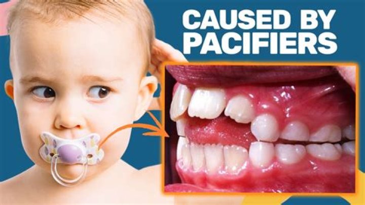 Can pacifier cause colic?