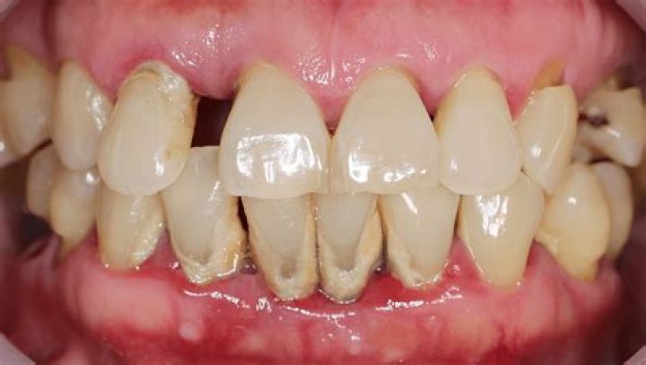 Can salt damage your teeth?