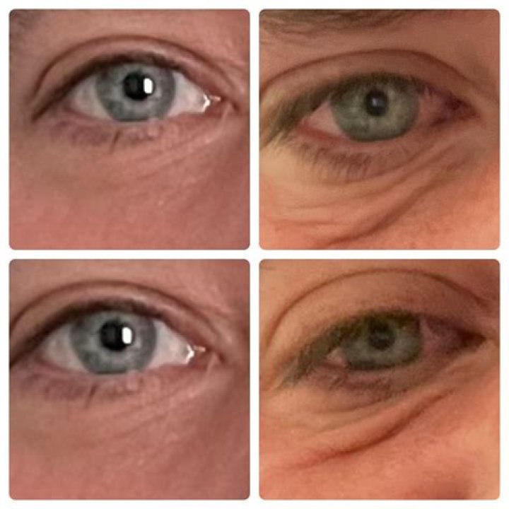 Can tretinoin be used under eyes?