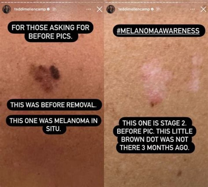 Do you feel tired with melanoma?