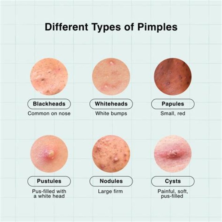 Does early morning urine cure pimples?