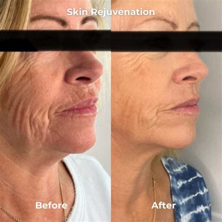 Does microneedling tighten double chin?