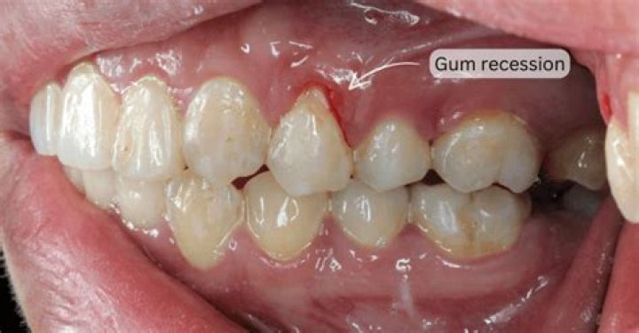 Does Sensodyne help with gum recession?
