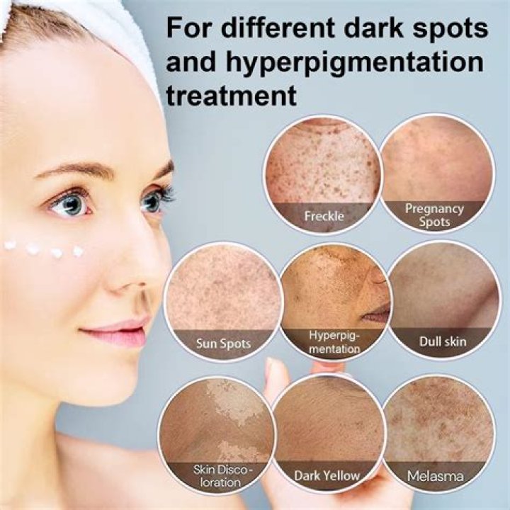 Does vinegar clear dark spots?