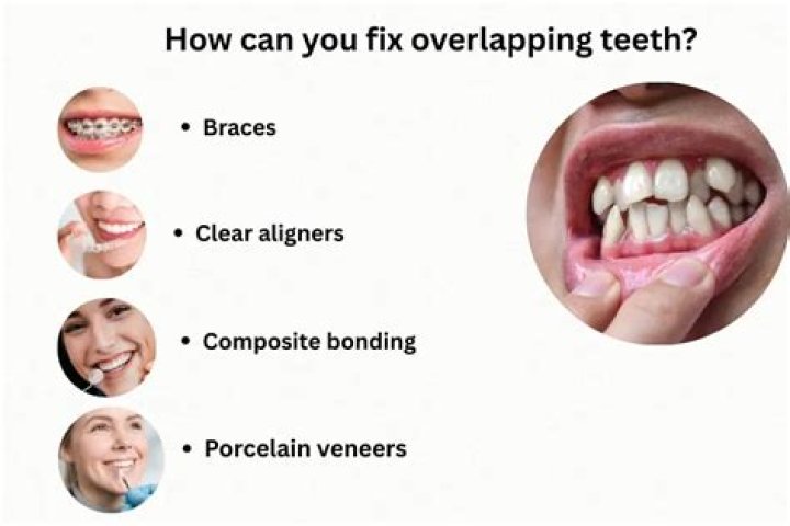 How can I fix overlapping my front teeth without braces?