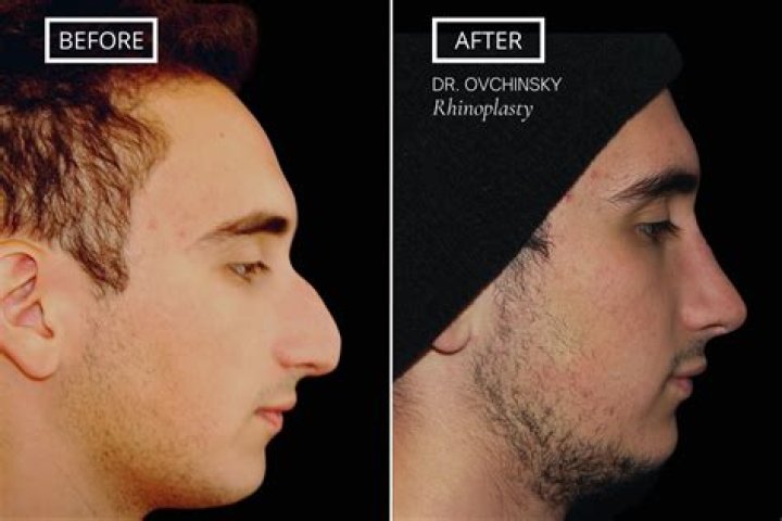 How can I make my nose smaller permanently without surgery?