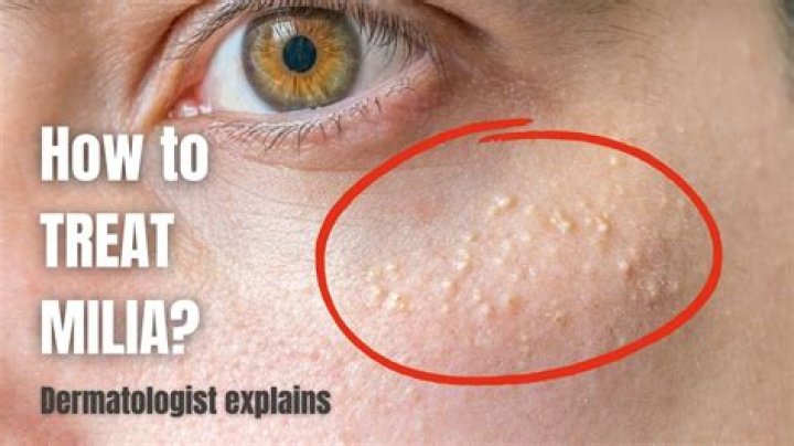 How can I reduce milia?