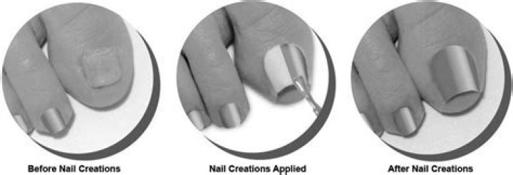 How do I protect my nail bed after losing my nail?