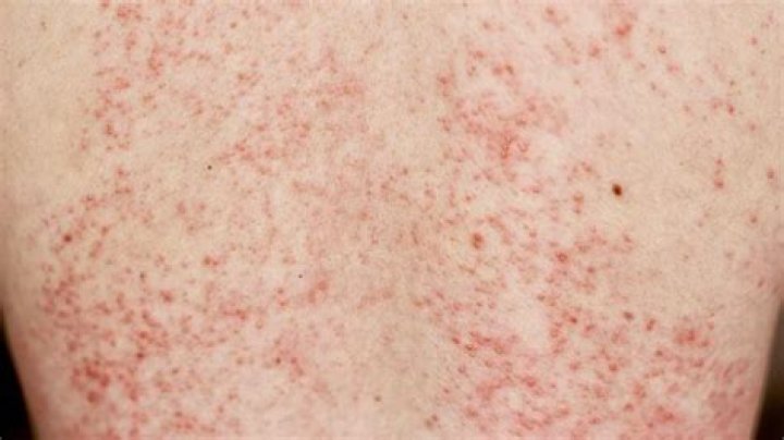 How long does a rash last?