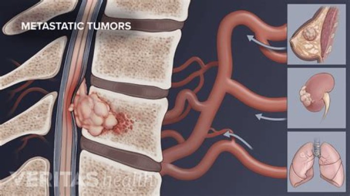 How would I know if I had a tumor on my spine?