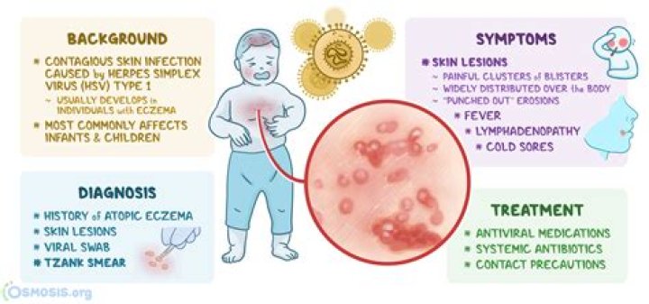 Is eczema caused by a virus?