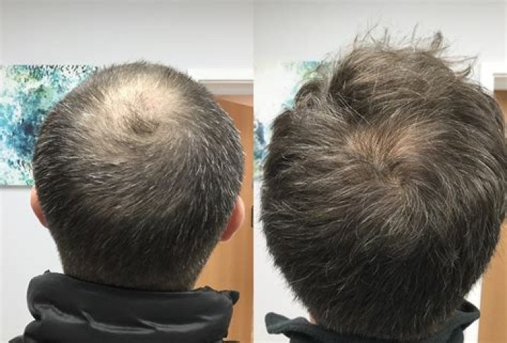 Is thinning hair permanent?