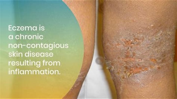 What climate is good for eczema?