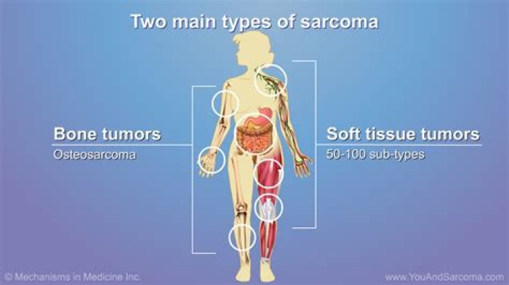 What do soft tissue sarcomas look like?