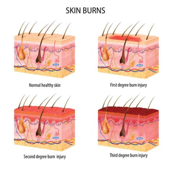 What happens if a burn is white?
