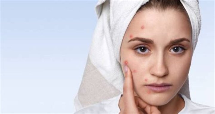 What is the best treatment for teenage acne?