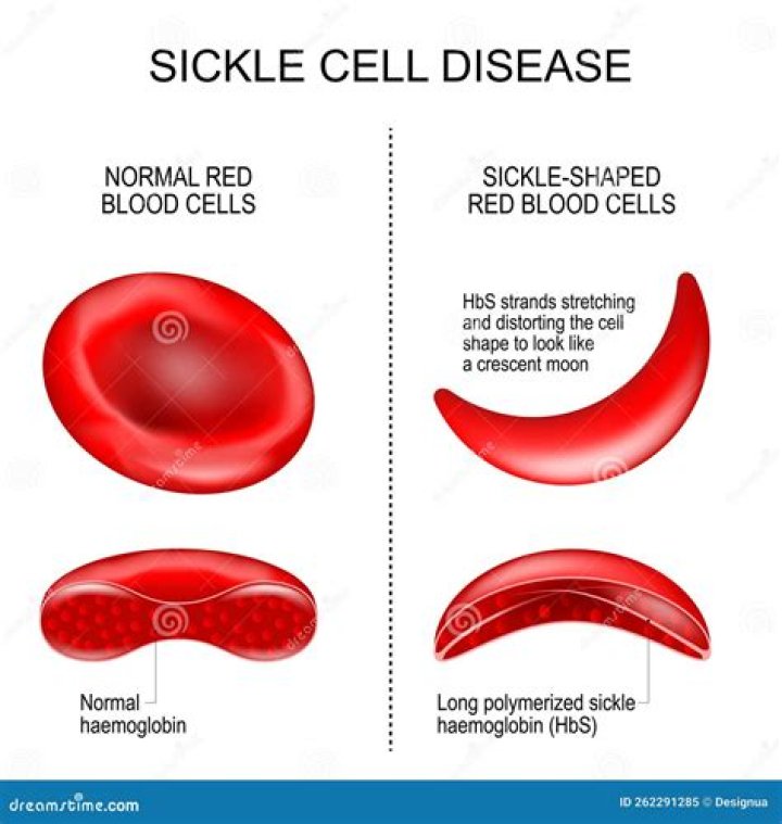 What is the difference between sickle cell anemia and sickle cell disease?