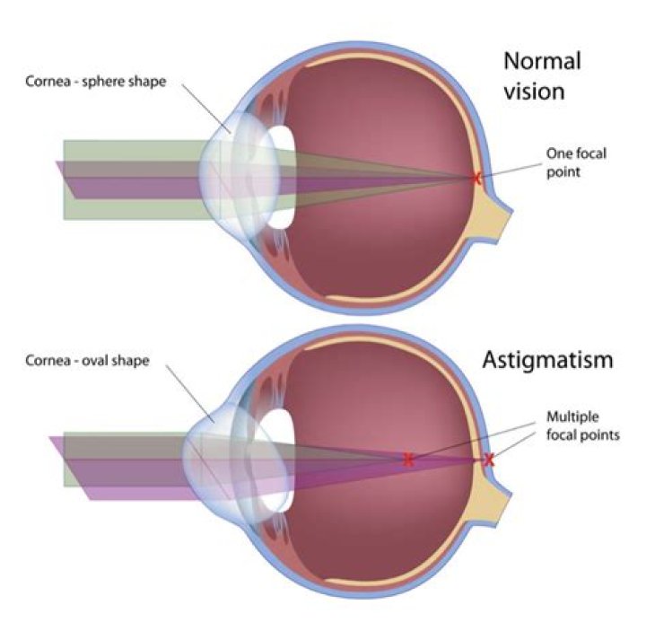 What makes astigmatism worse?