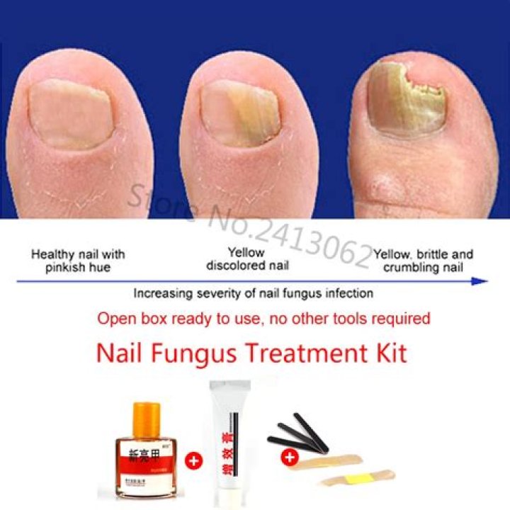 What spice cures toenail fungus?